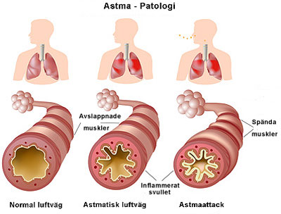 Beskrivning hur astma påverkar luftvägarna, patologi