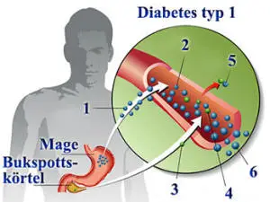 Diabetes typ 1 föranleder höga glukosvärden