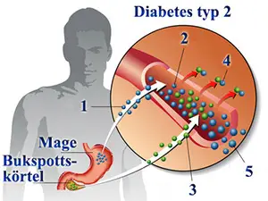 Diabetes typ 2 kan såväl som typ 1 medföra mögel och svamp