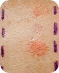 Pricktest i huden kan avslöja mögelallergi